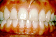 Perfect Smile disease free periodontium